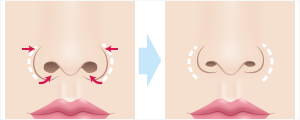 小鼻縮小＋α法(鼻翼縮小＋α法)　施術イメージ