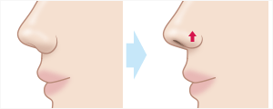 鼻翼挙上術　施術イメージ