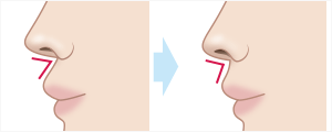 猫手術(鼻唇角形成術)　施術イメージ