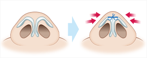 鼻尖縮小(鼻尖形成)　施術イメージ