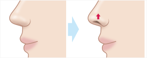 鼻孔縁挙上術　施術イメージ
