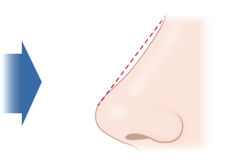 鼻中隔延長による隆鼻 イメージ
